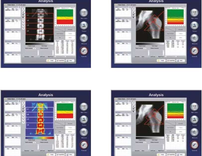 DXA Knochendichtemessung